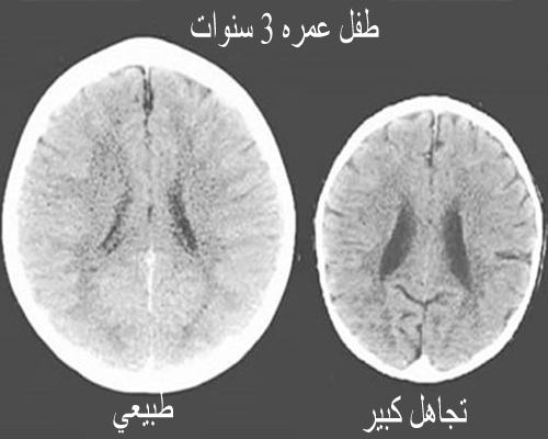 صورة سكانر تظهر التأثير المذهل للحب على دماغ الطفل Ifarasha