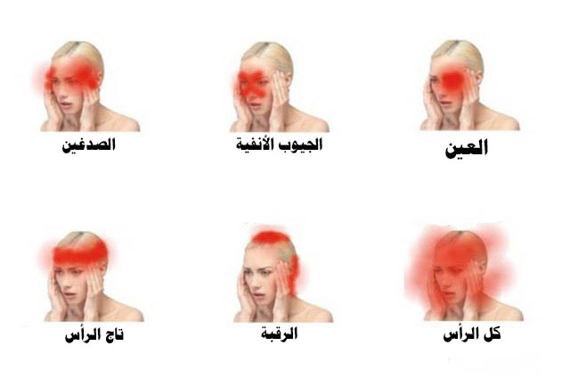 5 أنواع من أوجاع الرأس قد تشير إلى وجود مرض خطير Ifarasha