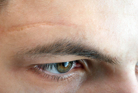 scar on forehead