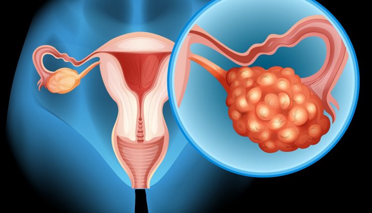 Ovarian cancer diagram in detail
