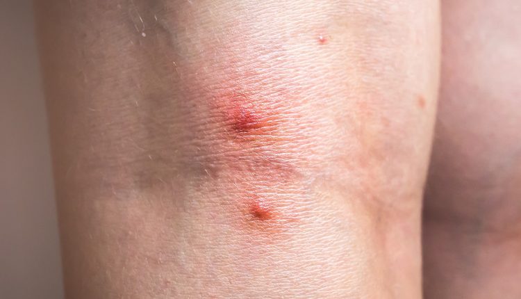 Mosquito bite on woman’s leg. Skin health problem. Red pimple.