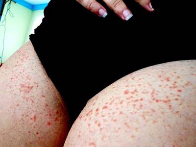 كيف فقدت 20 كلغ من وزني وشفيت من الصدفية بتغيير نظامي الغذائي