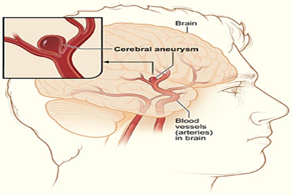 الأنورسما الدماغية Cerebral aneurysm أو أم الدم : مشكلة دماغية شائعة لا نعرف عنها شيئاً؟