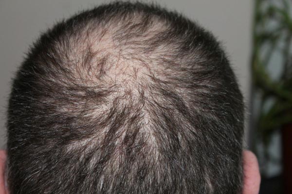 ضعوا هذا على فروة شعركم 10 دقائق وقولوا وداعاً لتساقط الشعر !