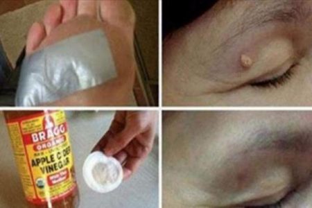 4 مكونات من مطبخكم ستجعل الثآليل والبقع البنية والزوائد اللحمية تختفي بسرعة ونهائياً !