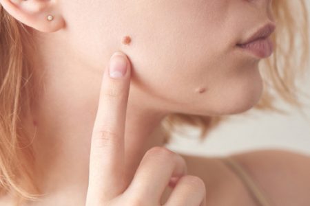 تخلصوا من الزوائد اللحمية بشكل سريع