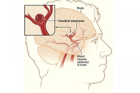 الأنورسما الدماغية Cerebral Aneurysm أو أم الدم: مشكلة دماغية شائعة لا نعرف عنها شيئاً؟