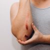 علاج طبيعي للحروق
