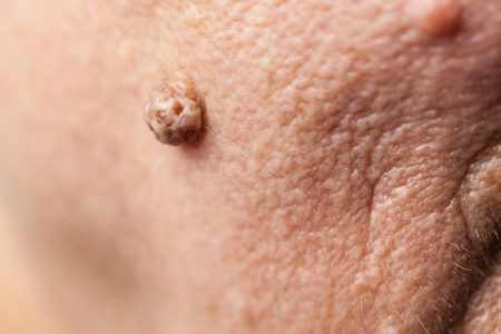 4 وصفات منزلية تزيل الزوائد الجلدية بسرعة دون أي أثر