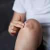 الكدمات على البشرة