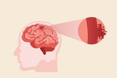 الجلطة الدماغية: تعرّفوا على هذه الطرق ال 4 كي تنقذوا حياتكم وحياة غيركم !