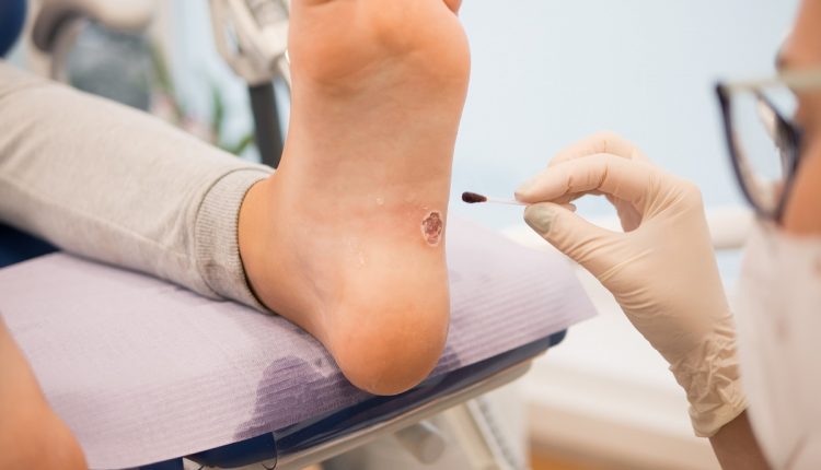 Podiatrist treating a verruca on a patient’s foot