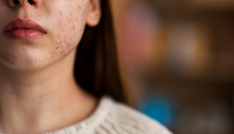person-dealing-with-rosacea