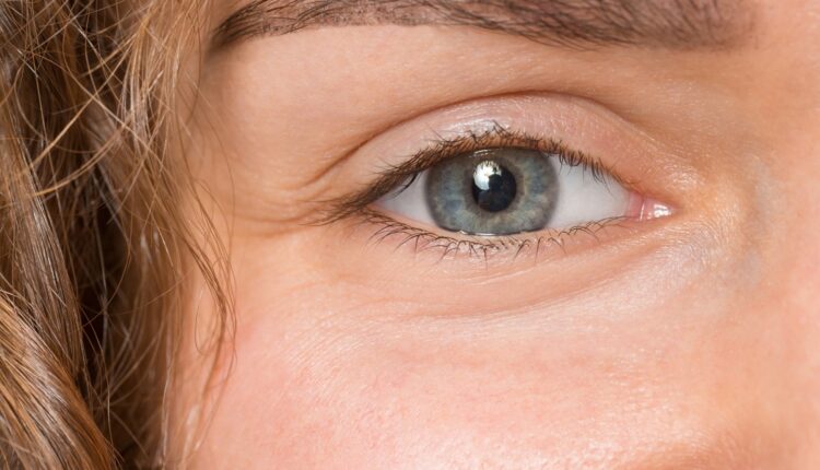 Droopy eyelids