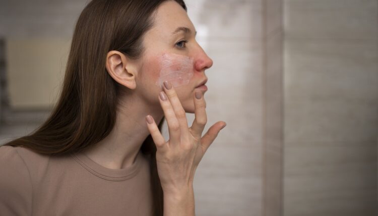 rosacea