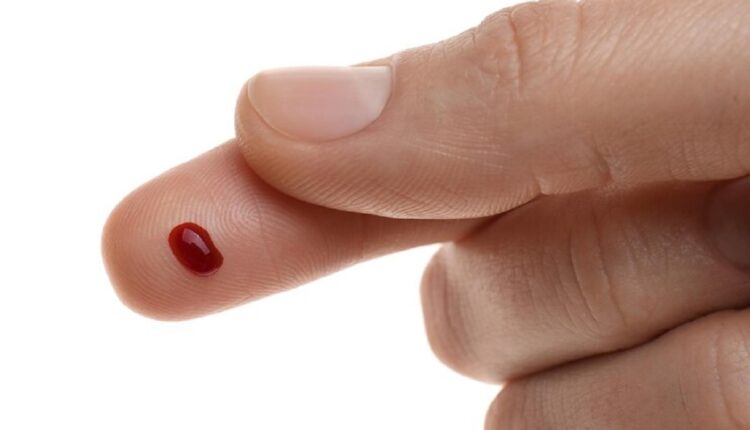 Wart
