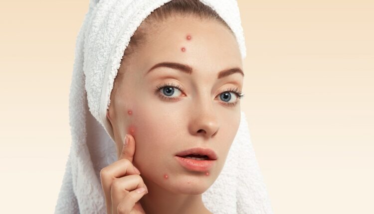 get rid of acne